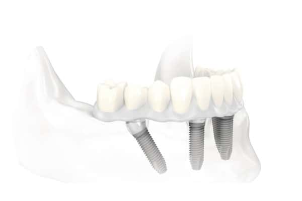 Dental Implant Services All on 4 Dental Implants Scottsdale