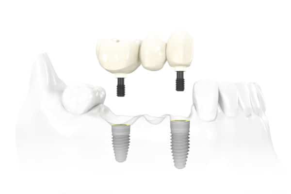 Dental Implant Services Multi-Tooth Dental Implants Scottsdale