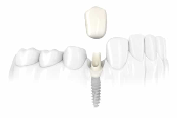 Dental Implant Services Single Tooth Dental Implants Scottsdale
